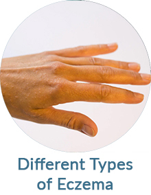 Different Types of Eczema Blog