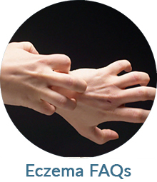 Is Eczema Contagious FAQs | Naples Soap Co.