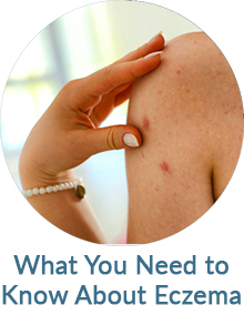 What You Need to Know About Eczema Blog